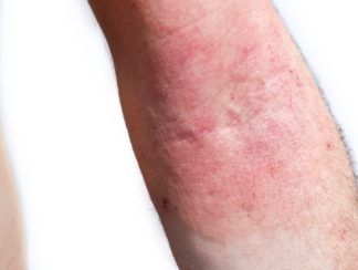 Heal Eczema Naturally in 5 Easy Steps
