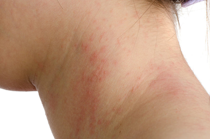 Do all allergies lead to anaphylaxis?